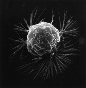 genes cáncer de mama