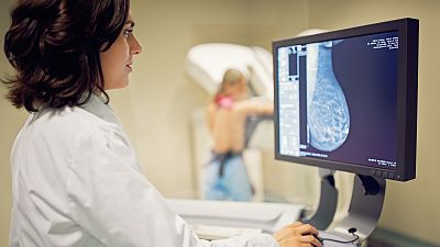Un nuevo modelo predice el riesgo de tener cáncer de mama en los próximos 20 años